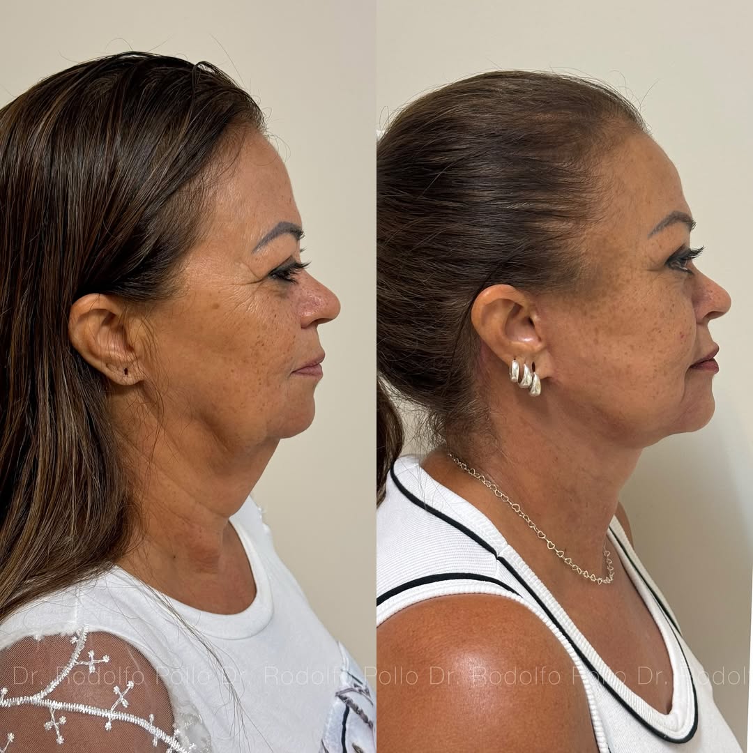 acabe-com-a-papada-em-fernandopolis