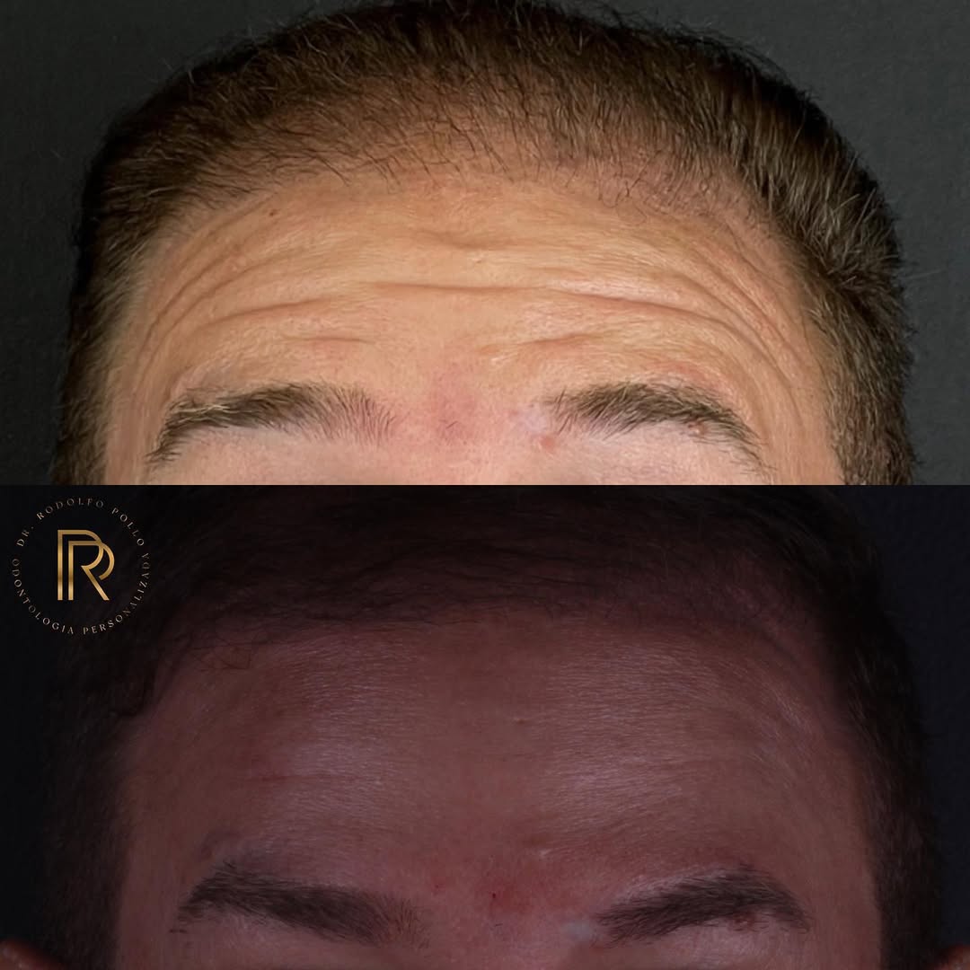 botox-em-fernandopolis