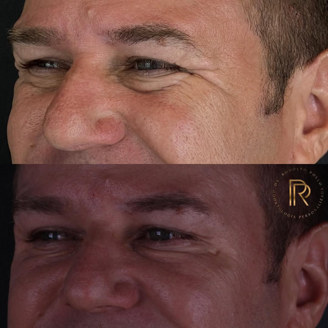 botox-fernandopolis