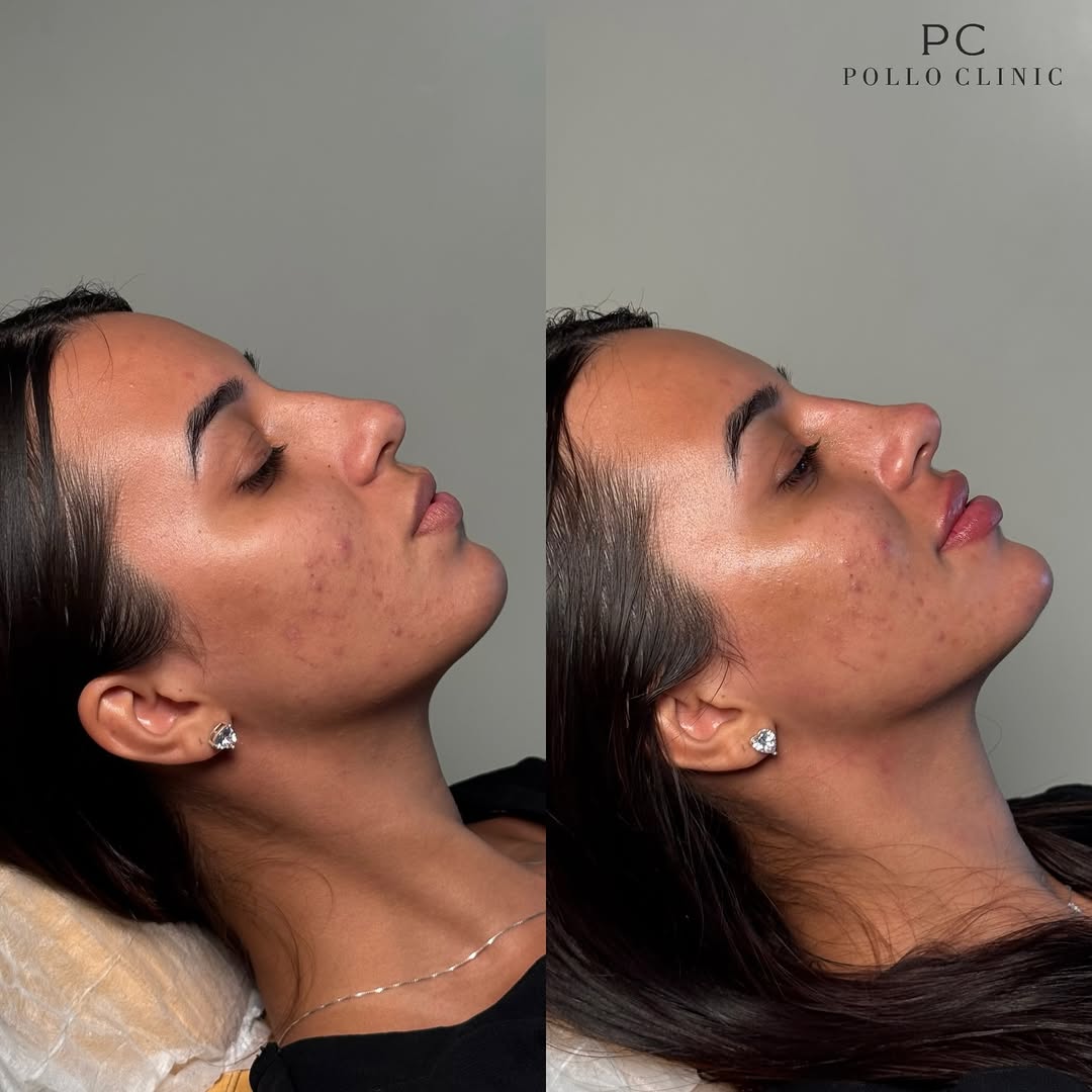 harmonização-facial-fernandopolis