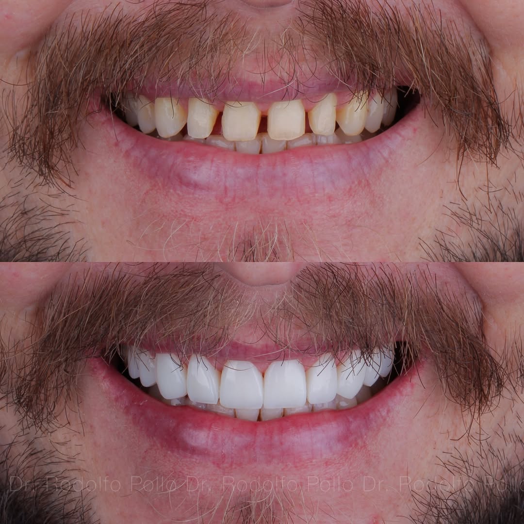 lente-de-contato-dental