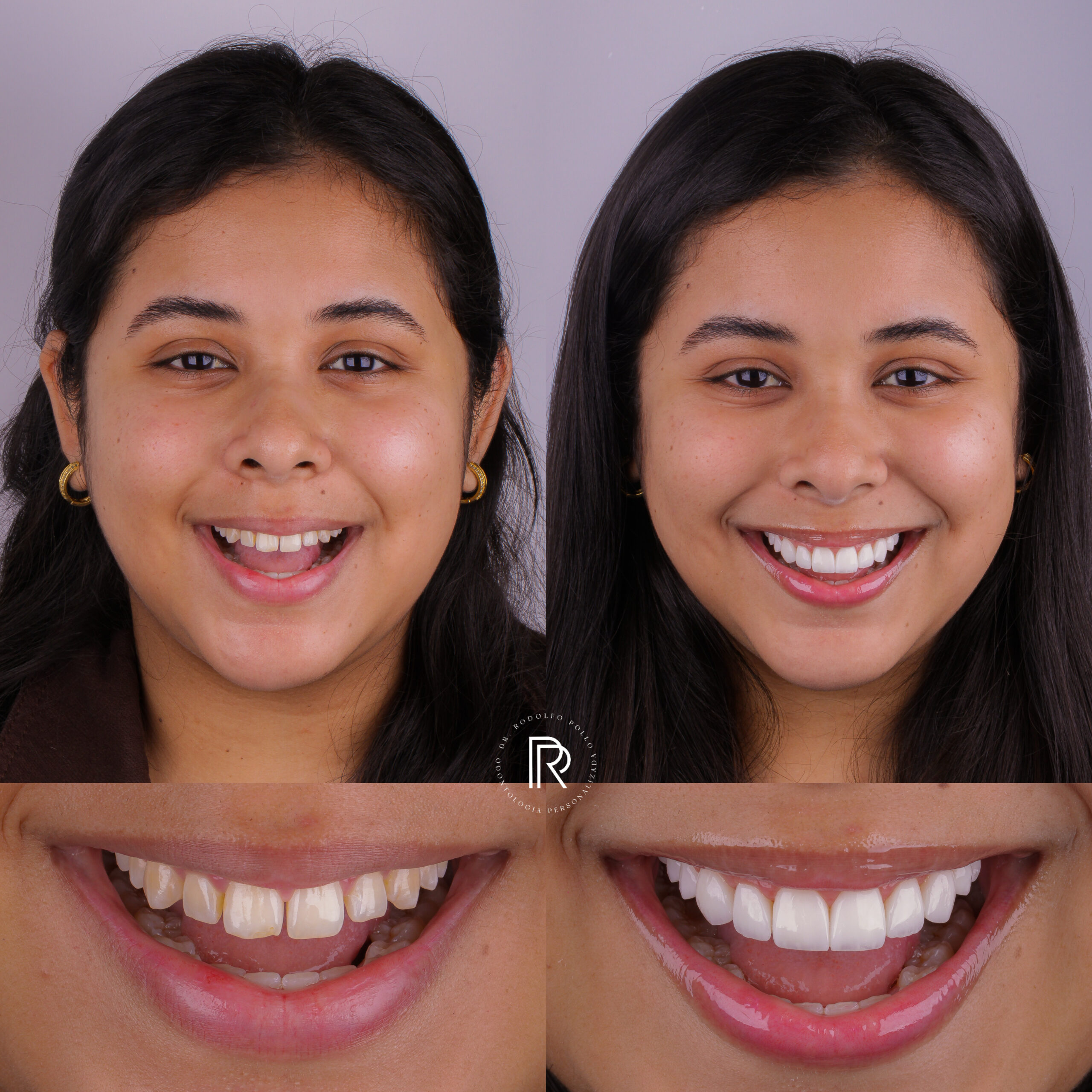 lentes de contato dental
