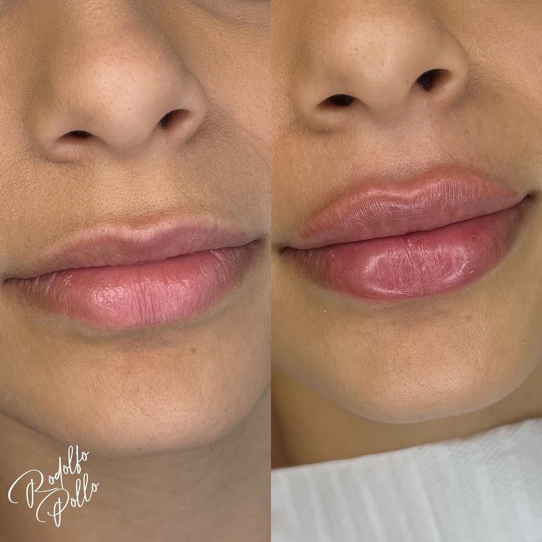 preenchimento-labial-fernandopolis